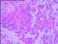 右颞叶胶质母细胞瘤？图7