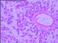 右颞叶胶质母细胞瘤？图8