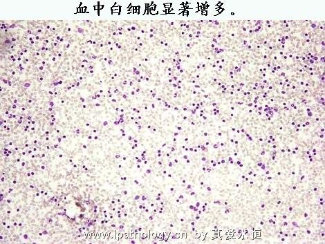 T细胞非霍奇金淋巴瘤并发淋巴瘤细胞白血病图1
