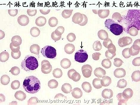 T细胞非霍奇金淋巴瘤并发淋巴瘤细胞白血病图2