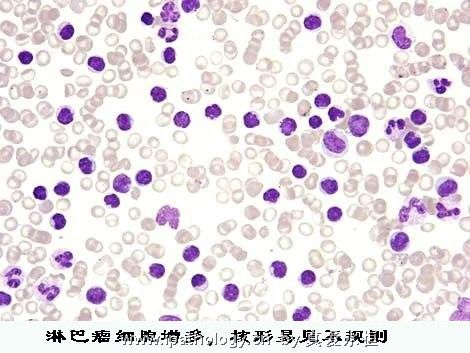T细胞非霍奇金淋巴瘤并发淋巴瘤细胞白血病图3