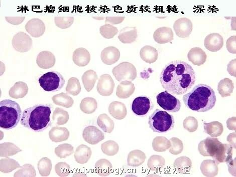 T细胞非霍奇金淋巴瘤并发淋巴瘤细胞白血病图4