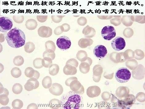 T细胞非霍奇金淋巴瘤并发淋巴瘤细胞白血病图5