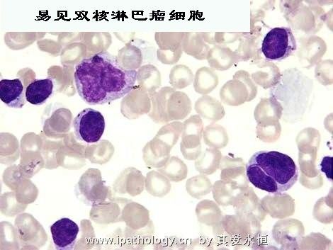 T细胞非霍奇金淋巴瘤并发淋巴瘤细胞白血病图6