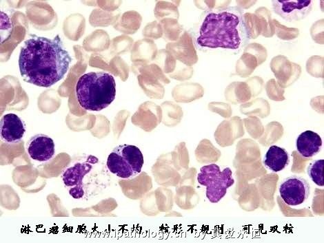T细胞非霍奇金淋巴瘤并发淋巴瘤细胞白血病图7