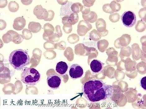 T细胞非霍奇金淋巴瘤并发淋巴瘤细胞白血病图8