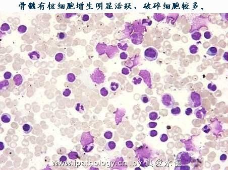 T细胞非霍奇金淋巴瘤并发淋巴瘤细胞白血病图9