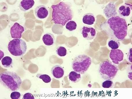 T细胞非霍奇金淋巴瘤并发淋巴瘤细胞白血病图10