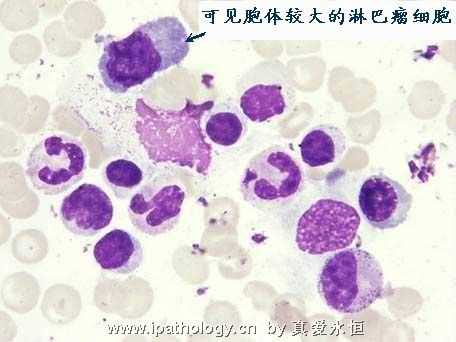 T细胞非霍奇金淋巴瘤并发淋巴瘤细胞白血病图11