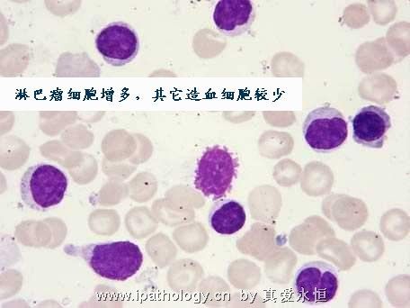 T细胞非霍奇金淋巴瘤并发淋巴瘤细胞白血病图12