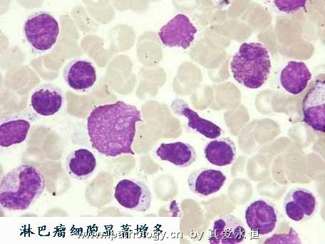 T细胞非霍奇金淋巴瘤并发淋巴瘤细胞白血病图13