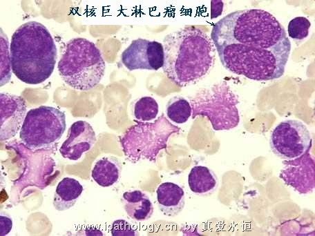T细胞非霍奇金淋巴瘤并发淋巴瘤细胞白血病图14
