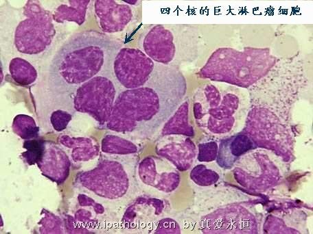 T细胞非霍奇金淋巴瘤并发淋巴瘤细胞白血病图15