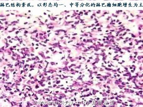 T细胞非霍奇金淋巴瘤并发淋巴瘤细胞白血病图22