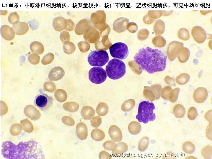 急性淋巴细胞白血病图2
