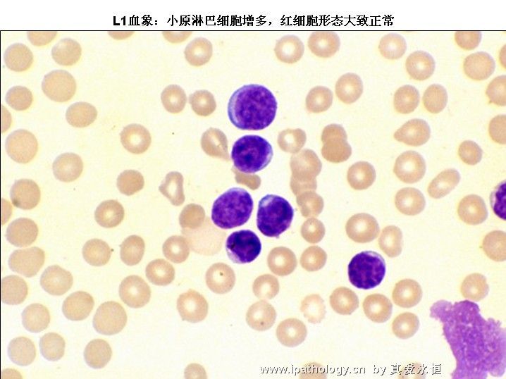 急性淋巴细胞白血病图3