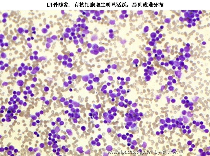 急性淋巴细胞白血病图4