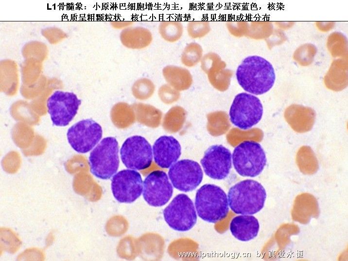 急性淋巴细胞白血病图5