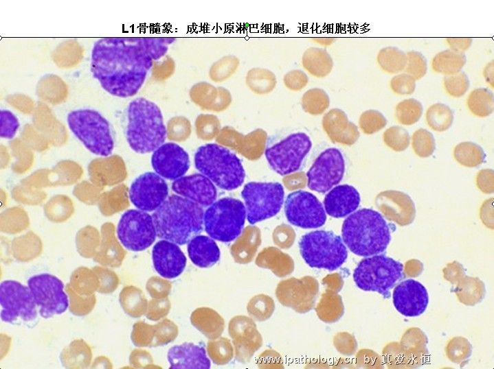 急性淋巴细胞白血病图6