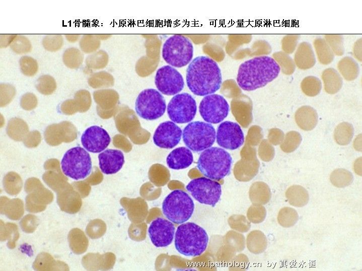急性淋巴细胞白血病图7