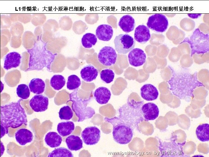 急性淋巴细胞白血病图8