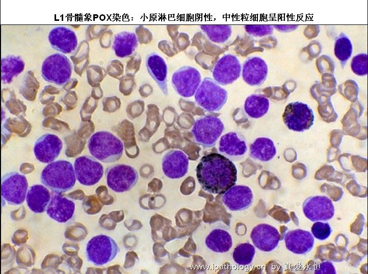 急性淋巴细胞白血病图9