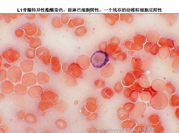 急性淋巴细胞白血病图10