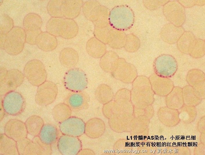 急性淋巴细胞白血病图11