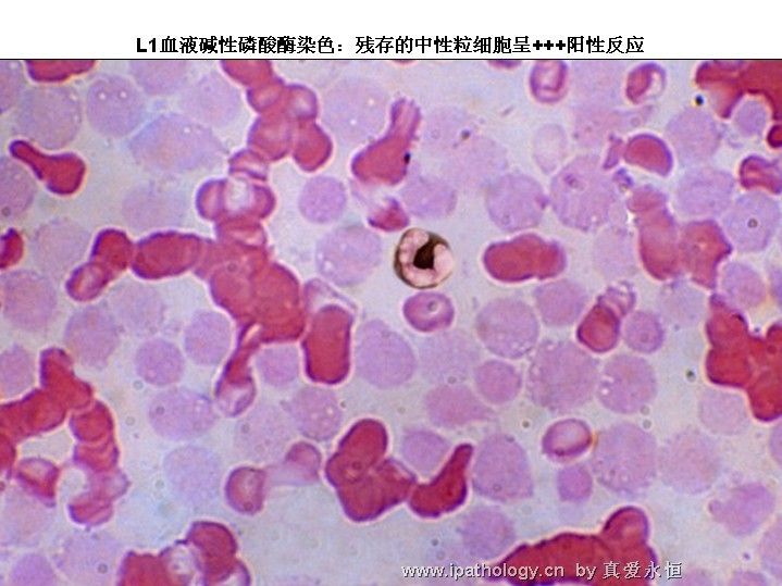 急性淋巴细胞白血病图12