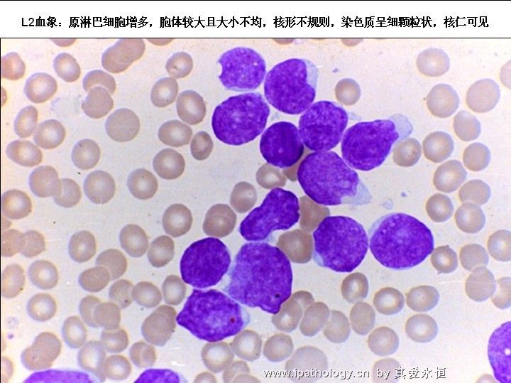 急性淋巴细胞白血病图13