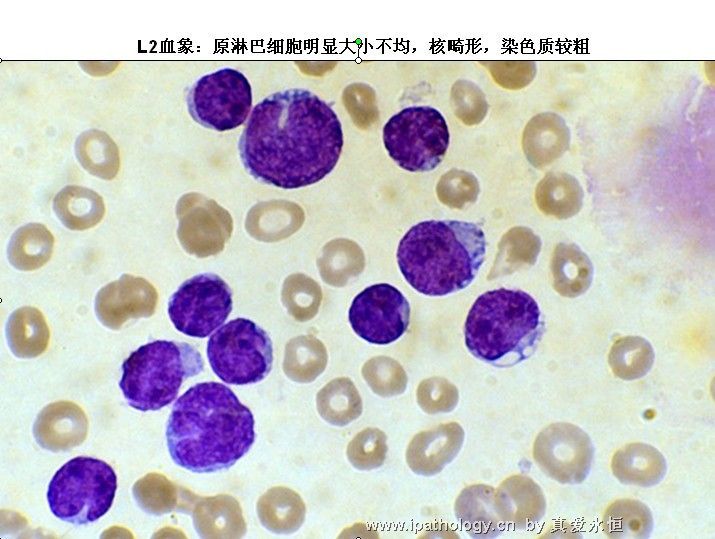 急性淋巴细胞白血病图14