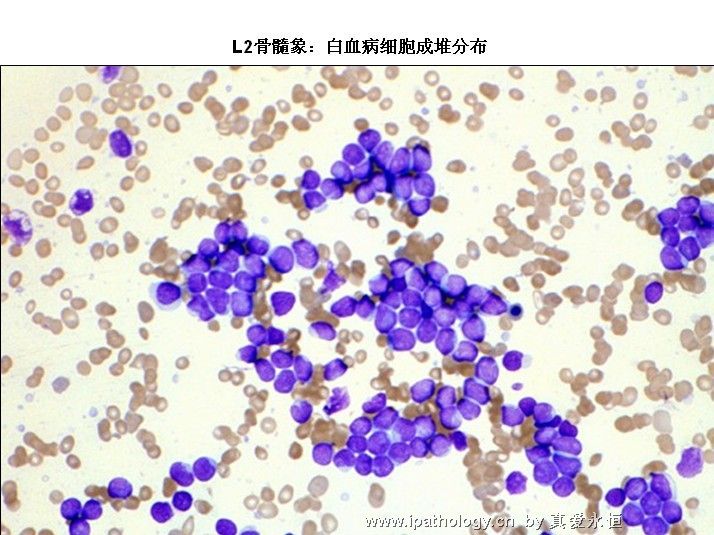 急性淋巴细胞白血病图15