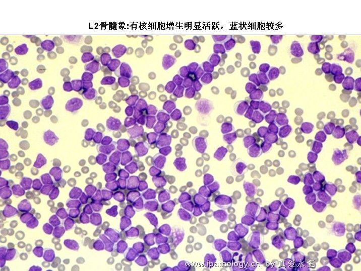 急性淋巴细胞白血病图16