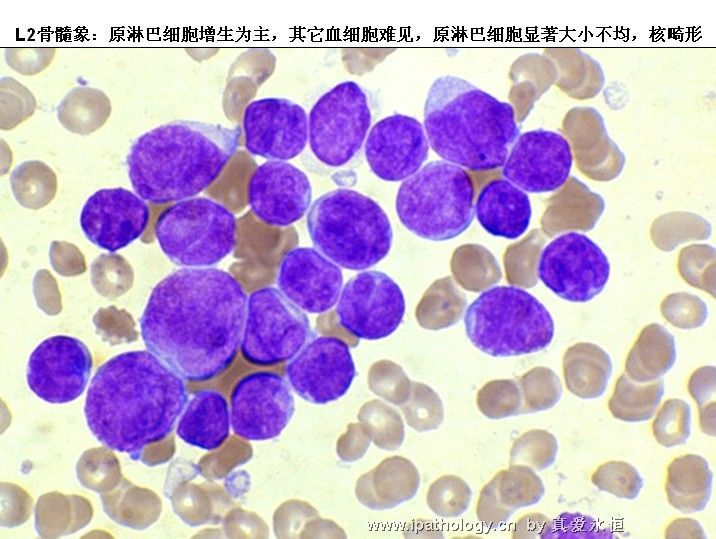 急性淋巴细胞白血病图17