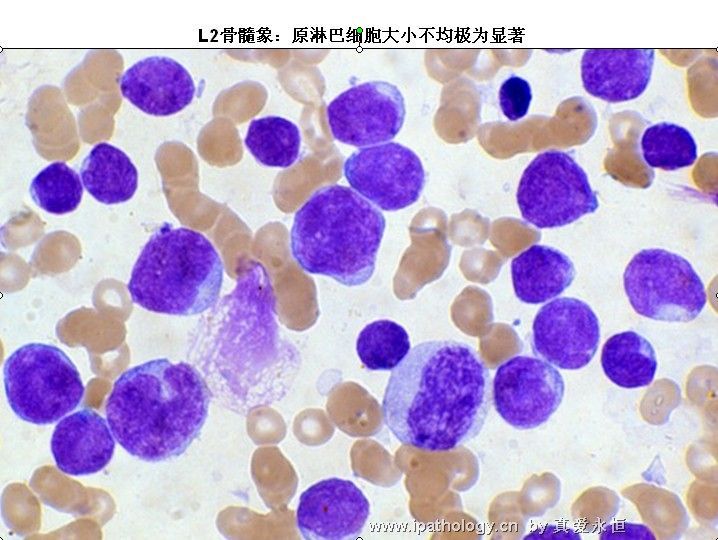急性淋巴细胞白血病图18