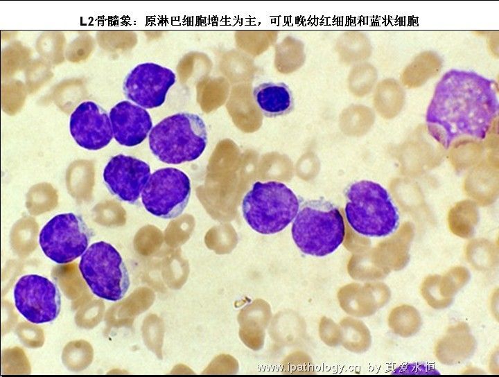 急性淋巴细胞白血病图19