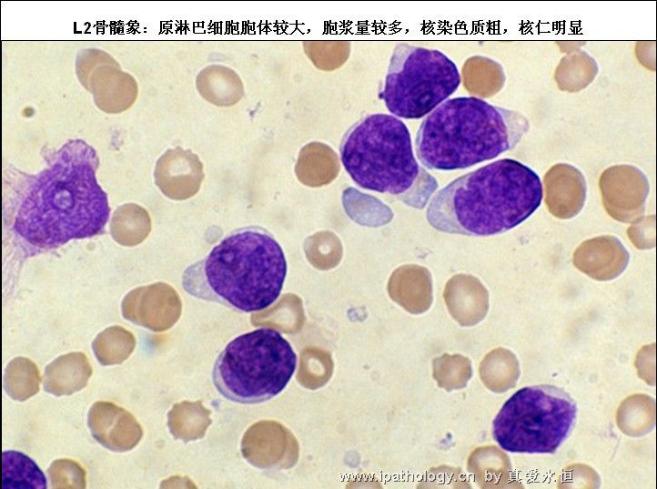 急性淋巴细胞白血病图20