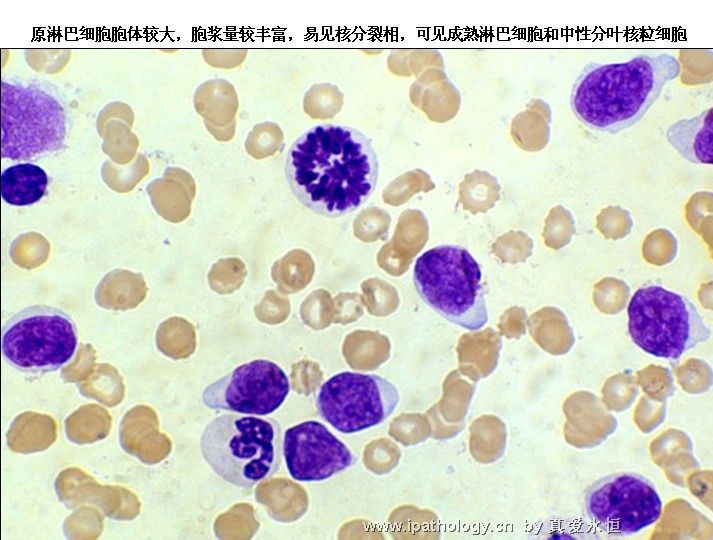 急性淋巴细胞白血病图21