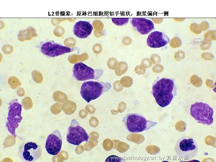 急性淋巴细胞白血病图22