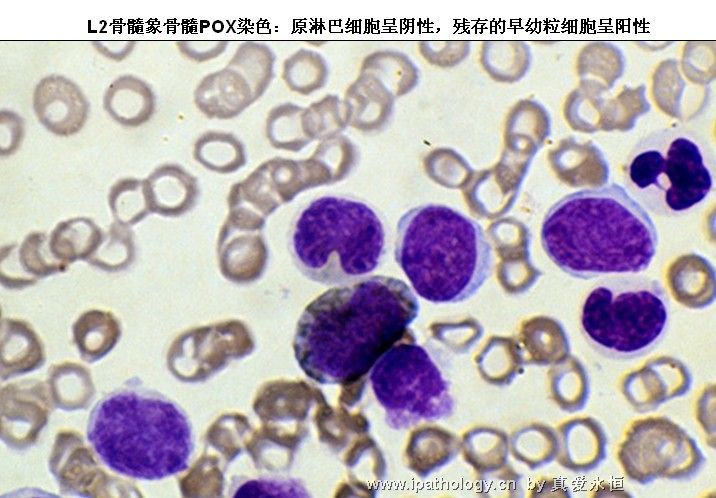 急性淋巴细胞白血病图23