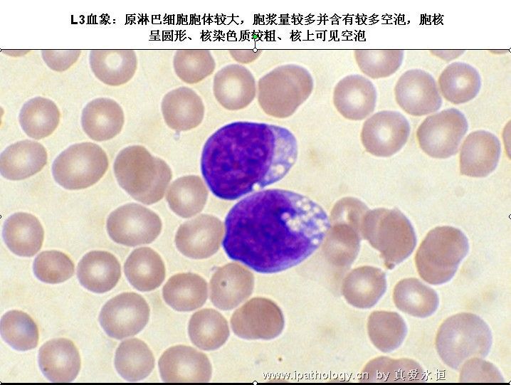 急性淋巴细胞白血病图24