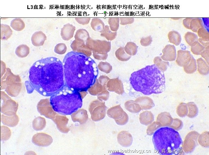 急性淋巴细胞白血病图25