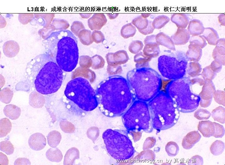 急性淋巴细胞白血病图26
