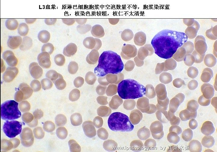 急性淋巴细胞白血病图27