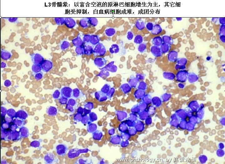 急性淋巴细胞白血病图28