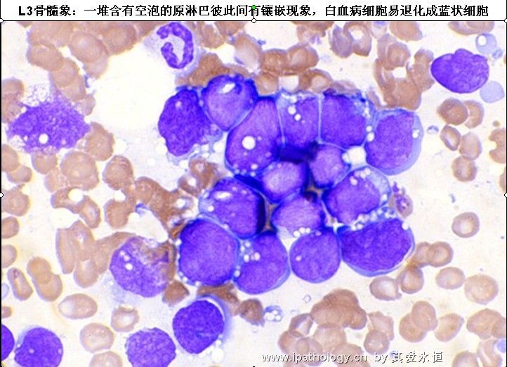 急性淋巴细胞白血病图29