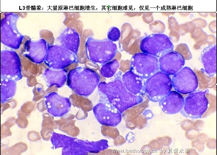 急性淋巴细胞白血病图30