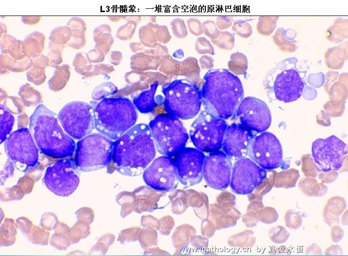 急性淋巴细胞白血病图31
