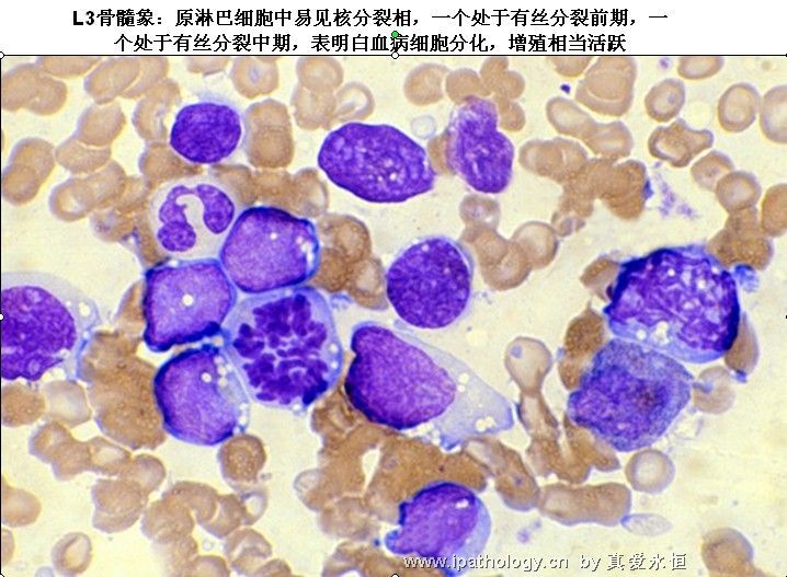 急性淋巴细胞白血病图32