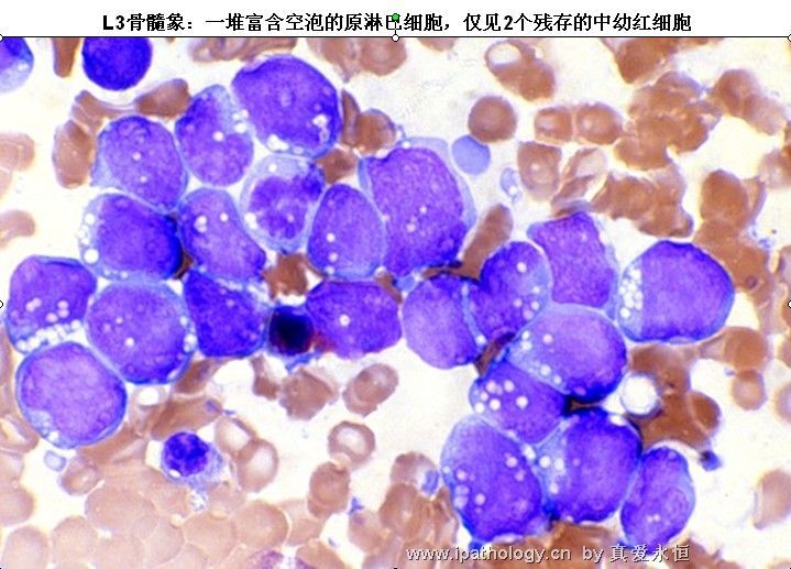 急性淋巴细胞白血病图33